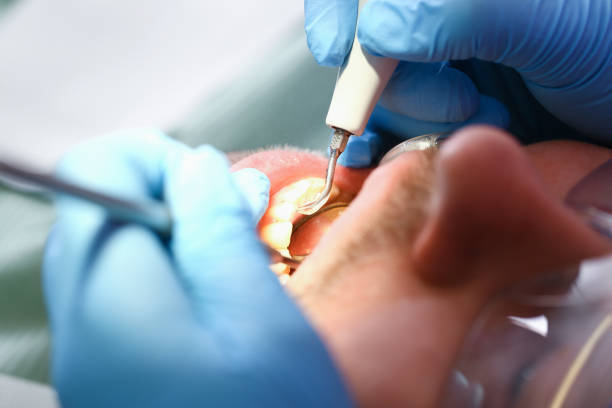 Best Emergency Dentist for Lost Fillings or Crowns in Berry Creek, CA