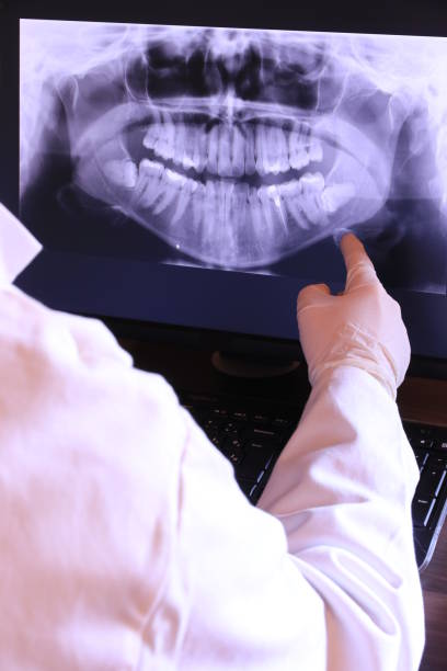 Best Emergency Dental Extractions in Berry Creek, CA